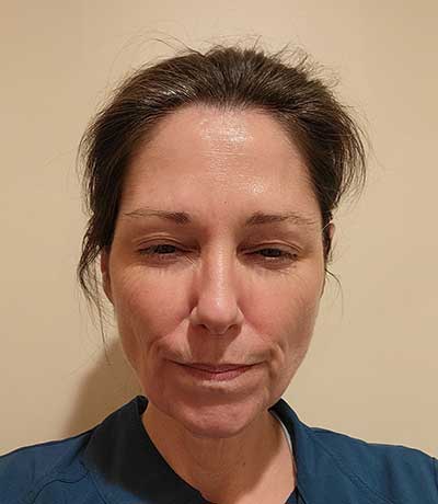 Patient attempts frown after receiving BOTOX