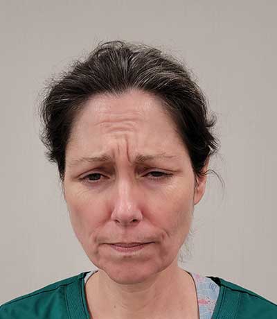 Patient frowning before BOTOX